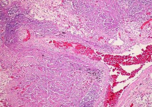 Vitamina C poderia acabar com tuberculose resistente a medicamentos