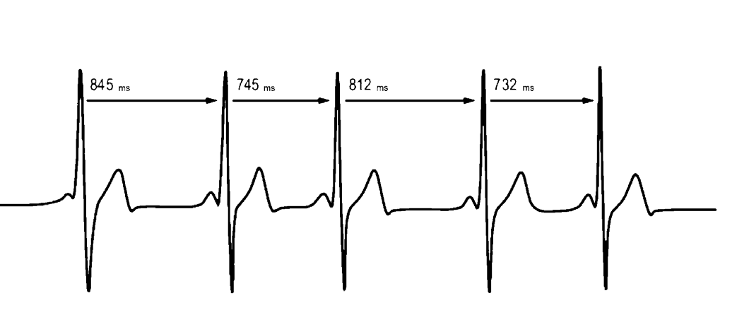 Medição da variabilidade da frequência cardíaca (VFC) pode ser útil para treinamentos físicos