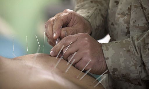 Acupuntura para melhorar a qualidade de vida dos cuidadores