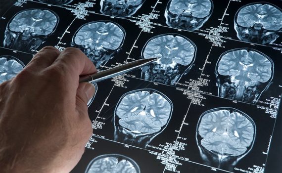 Inteligência artificial para o diagnóstico precoce do Alzheimer