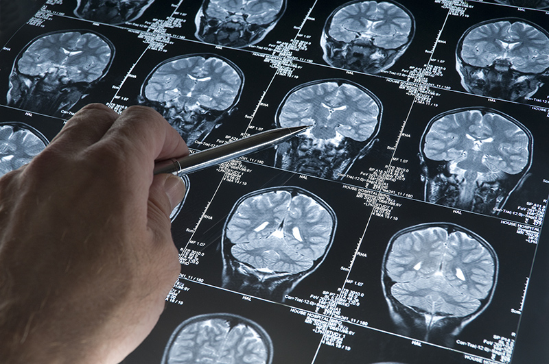 Inteligencia artificial para el diagnóstico precoz del Alzheimer