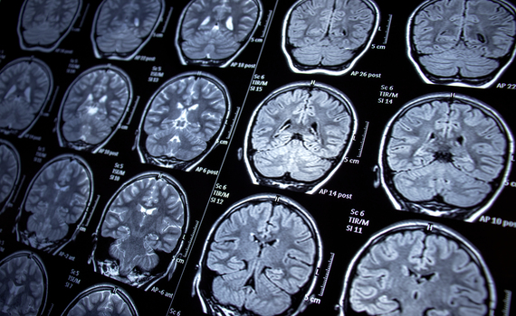Descubren qué pacientes con epilepsia no sufrirán afectaciones cognitivas